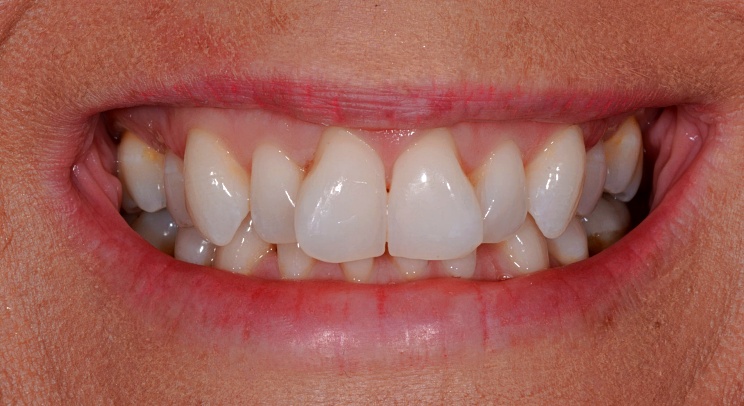 Case 1 After