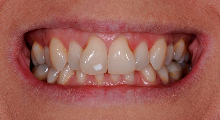 Case 1 Before