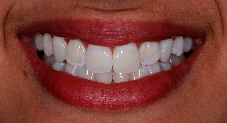 Case 2 After