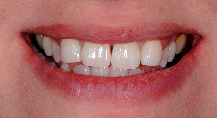 Case 4 After