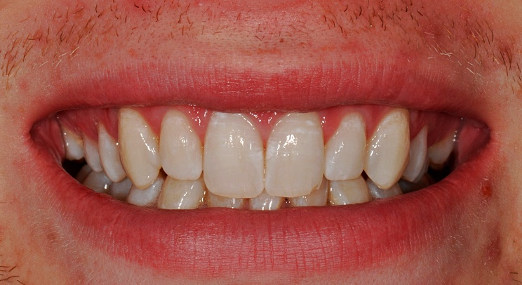 Case 5 After
