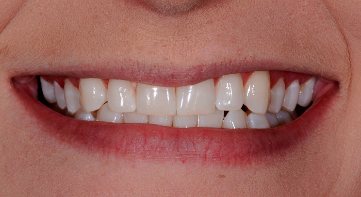 Case 6 after