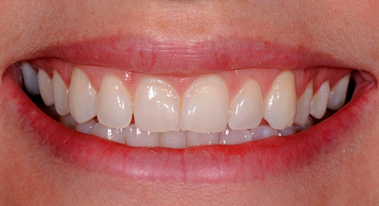 Case 8 after