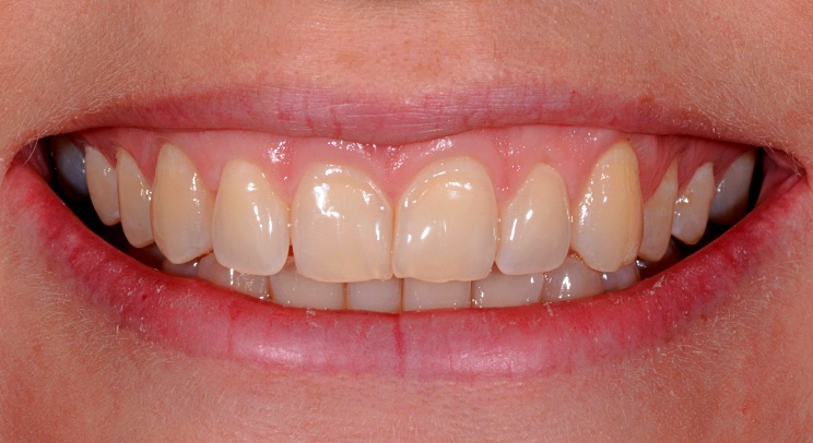Case 8 before